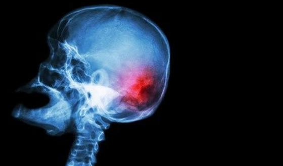 Ken jij de symptomen van een beroerte of CVA? | gezondheid.be