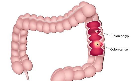 Hoe Ontstaan Darmpoliepen Gezondheid be hoe-ontstaan-darmpoliepen-gezondheid-be