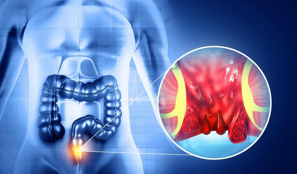 Speen: wat zijn aambeien en wat kan je doen? | gezondheid.be