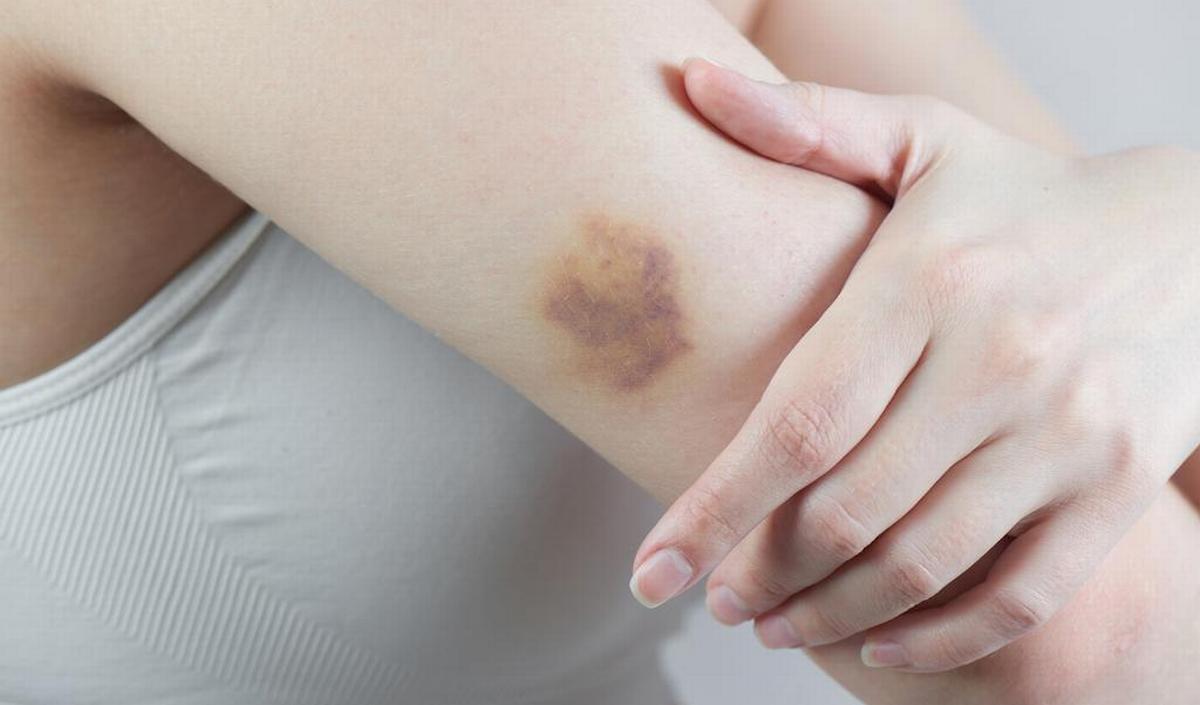 Waarom krijgt de ene sneller blauwe plekken dan de andere? | gezondheid.be