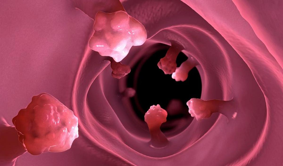 Dai polipi al cancro del colon: l’importanza dello screening