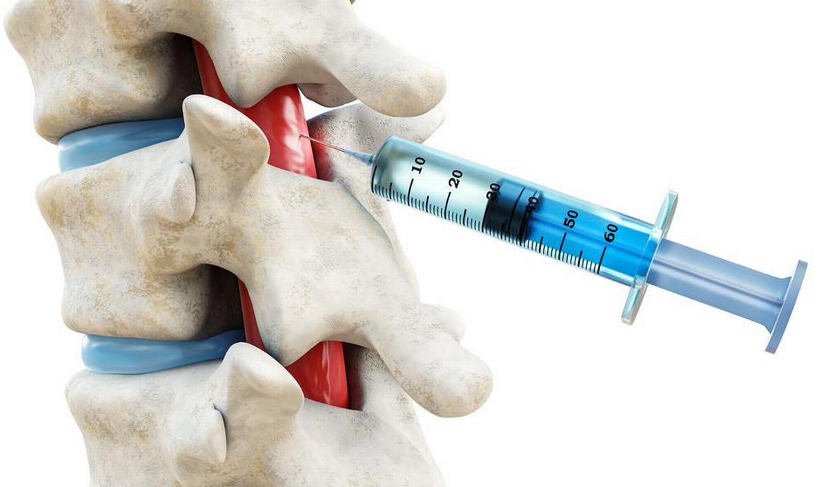 Infiltrazioni nel mal di schiena: procedura ed effetti collaterali