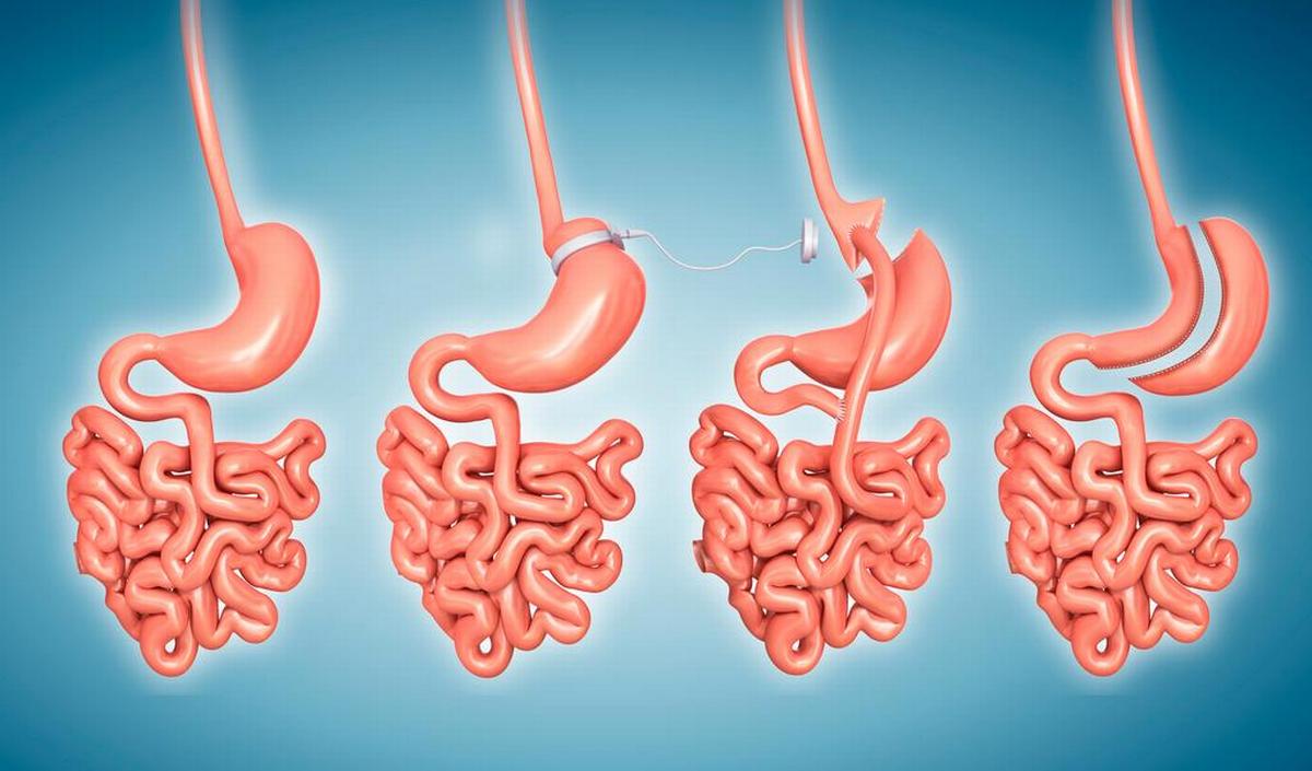 Wat is een gastric bypass en hoe verloopt de operatie? gezondheid.be