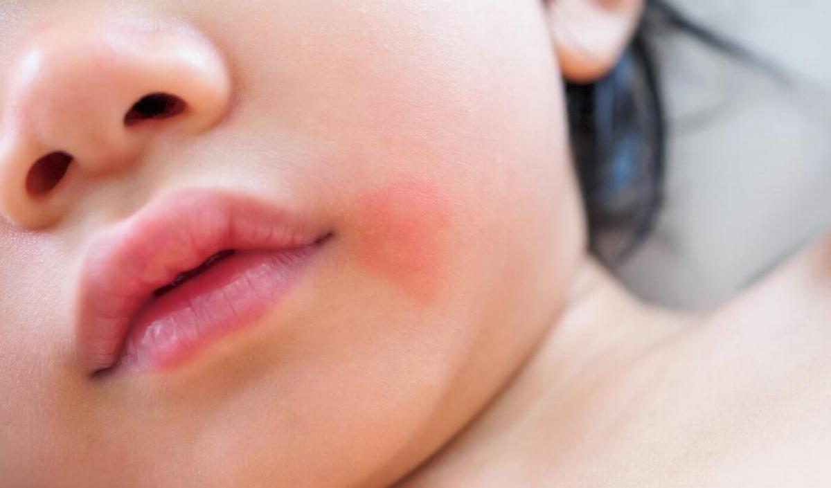 Pityriasis alba: inizialmente compaiono macchie rosse o rosa sulla pelle, poi macchie bianche