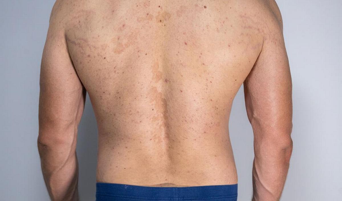 Pityriasis versicolor: cosa sono quelle macchie marroni sulla pelle?