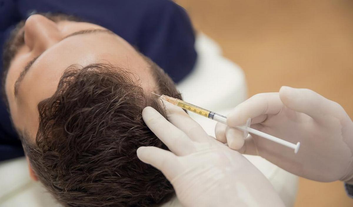 PRP : Stimuler la pousse des cheveux grâce à des injections de plasma dans le cuir chevelu
