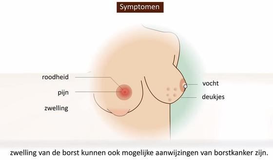 Video: Borstkanker | gezondheid.be