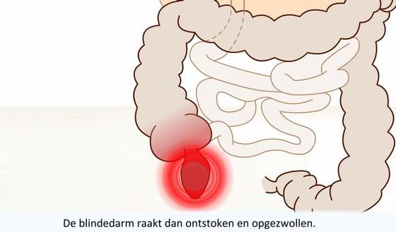 Video: Appendicitis | gezondheid.be